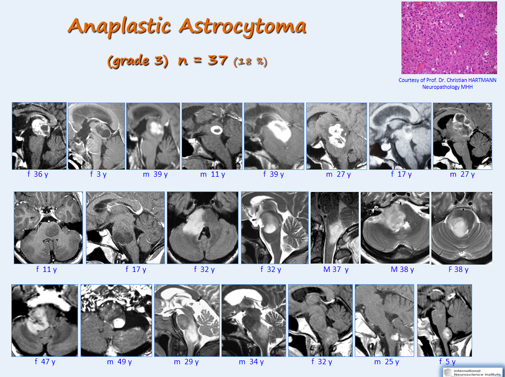 巴教授间变性星形细胞瘤手术系列：