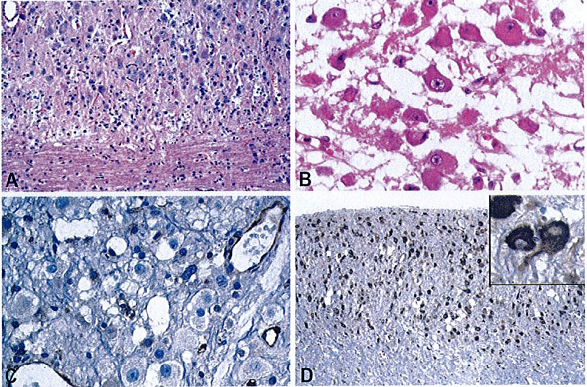 目前尚不清楚小脑发育不良性节细胞瘤是小脑皮质瘤性还是错构瘤性病变；如果是瘤性，则对应WHO 1级。其组织学表现为小脑白质减少，并存在异常肥大的神经节细胞，与浦肯野细胞颇为相似。  　　图：小脑发育不良性节细胞瘤的组织学特点。