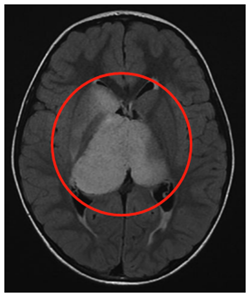 肿瘤已经导致脑室轻度增大、膈膜水肿等，且肿瘤内部囊肿明显。