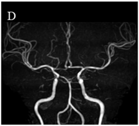 颅内动脉壁不规则(图D)