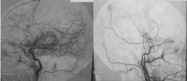 血管造影显示烟雾病