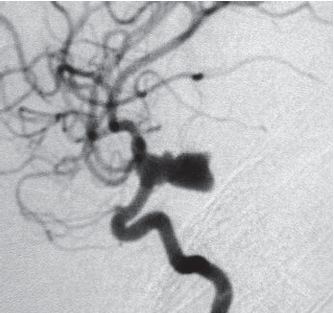 第一次手术前右颈内动脉的侧视图血管造影，显示一个向后突出的巨大囊状动脉瘤。