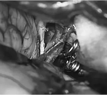 显示夹闭动脉瘤的显微图像。在颈内动脉表面未观察到明显异常。ICA：颈内动脉，ON：视神经。