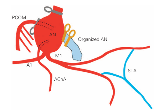 显示术中解剖特征的外科手术图。
