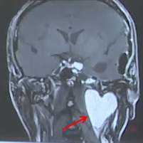 我的脑子里有颗爱心?这是肿瘤危险“示爱”