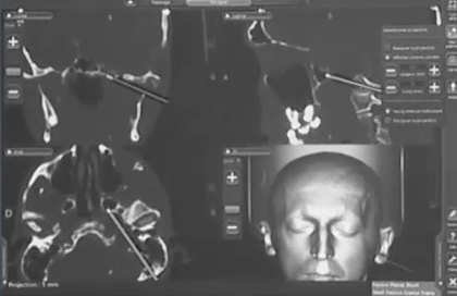 特别值得一提的是那条隐藏在后半规管下方的迷路后走廊，后半规管下方是一条通往岩尖的好路线。