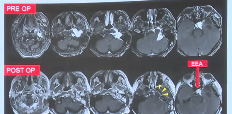 运用“筷子”技术，继续切除残留在海绵窦内的肿瘤。这颗“猖狂的爱心”最终落荒而逃。