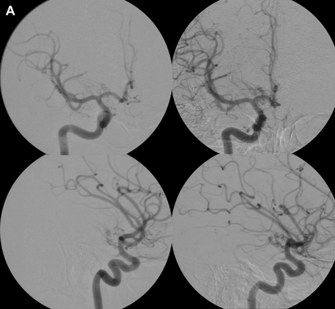 术前：经右侧颈内动脉（ICA）注射造影的脑血管正位（上图）与侧位（下图）诊断性血管造影片，显示颞叶内侧及视束存在由右侧脉络膜前动脉（AChA）供血的动静脉畸形（AVM）。