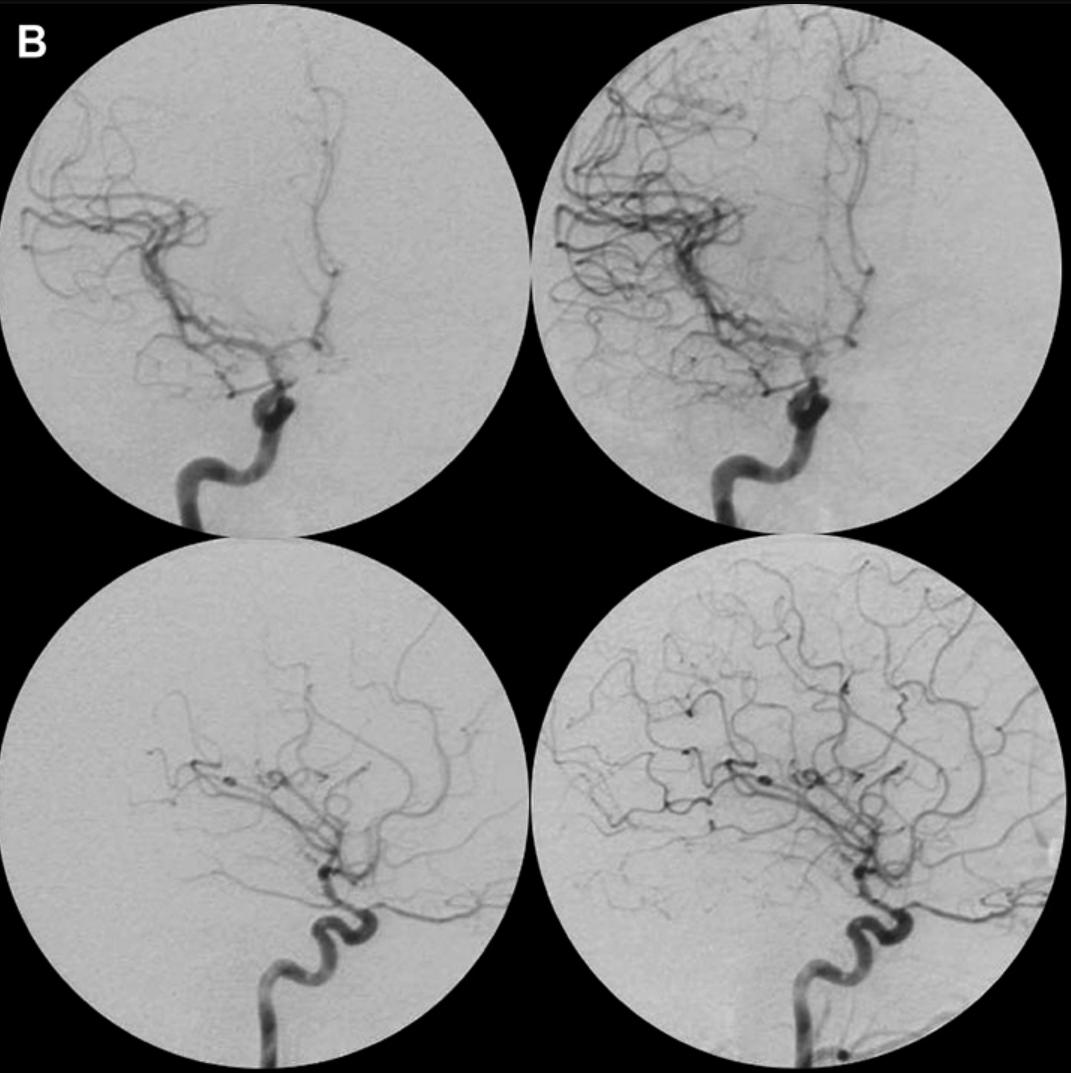术后：同角度血管造影片，证实AVM被完全切除，无残留畸形团及动静脉分流现象。