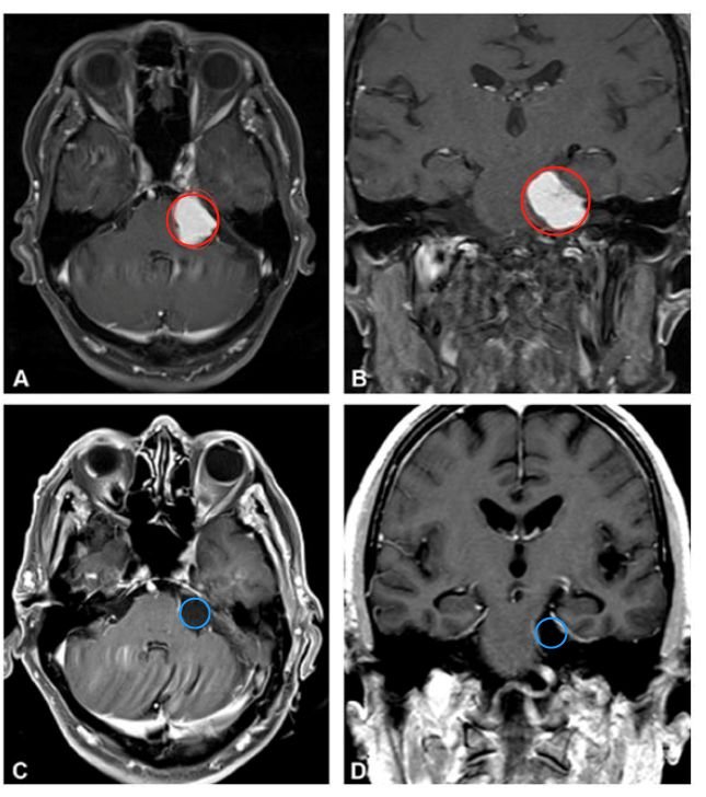 (A、B为术前影像，C、D表示术后影像)