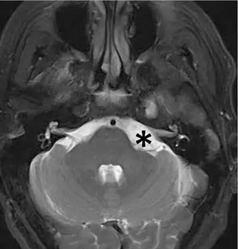 图 1 *号所标位置附近即为桥小脑角区，此处可见