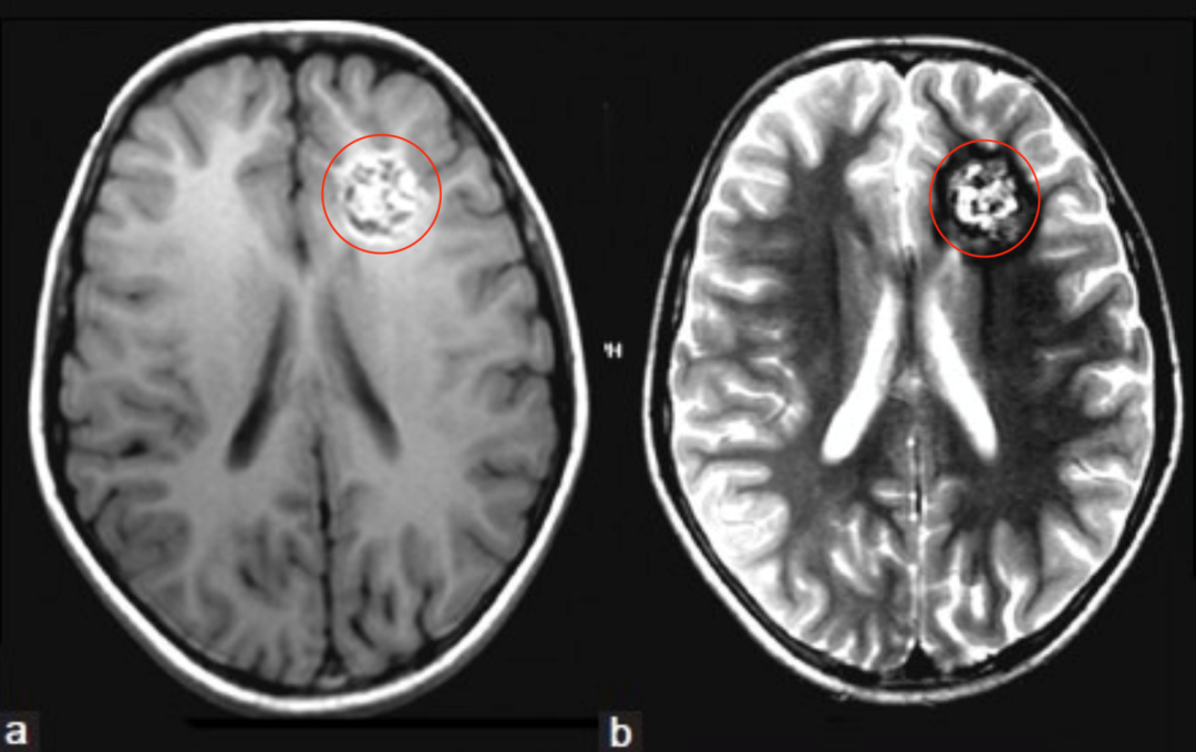图：(a)和(b) MRI T1W、T2W轴位图像显示混合信号的网状核心，代表不同退化状态的血液，注意T2W图像(b)中含铁血黄素的低聚晕