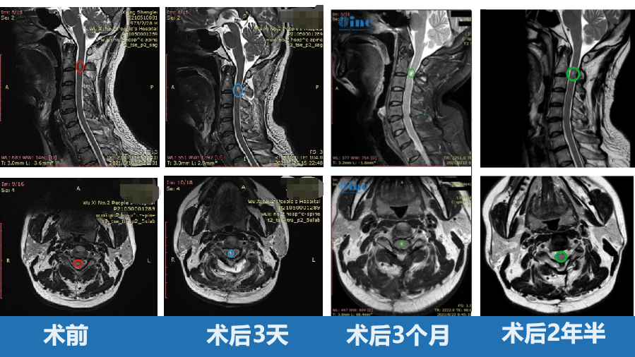 术前颈 2 平面脊髓内可见椭圆形短 T1 长 T2 信号,信号较均匀,边界尚清,大小约 7. 8X4.1X5.0mm,增强后明显强化。术后肿瘤得到顺利全切,无新发神经损伤,无瘫痪,术后复查未复发。