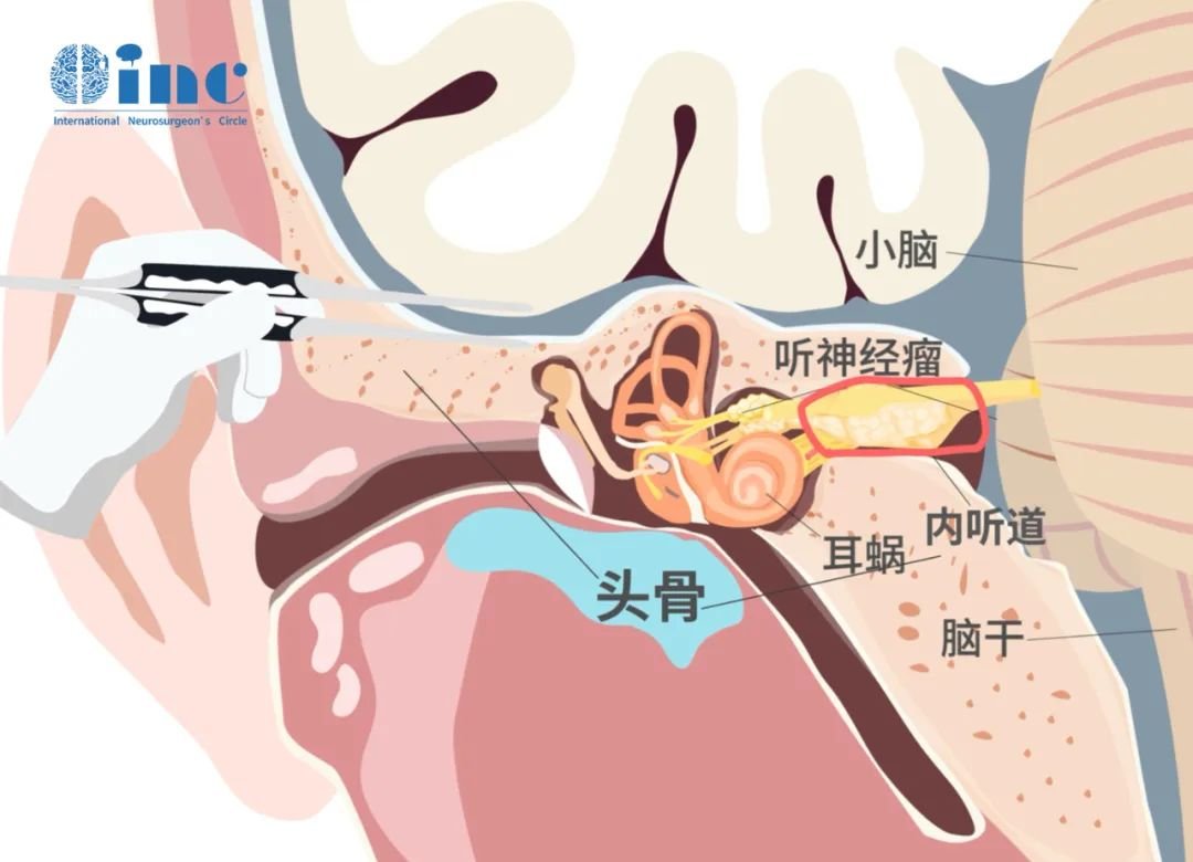“冰淇淋”征听神经瘤是怎么回事？