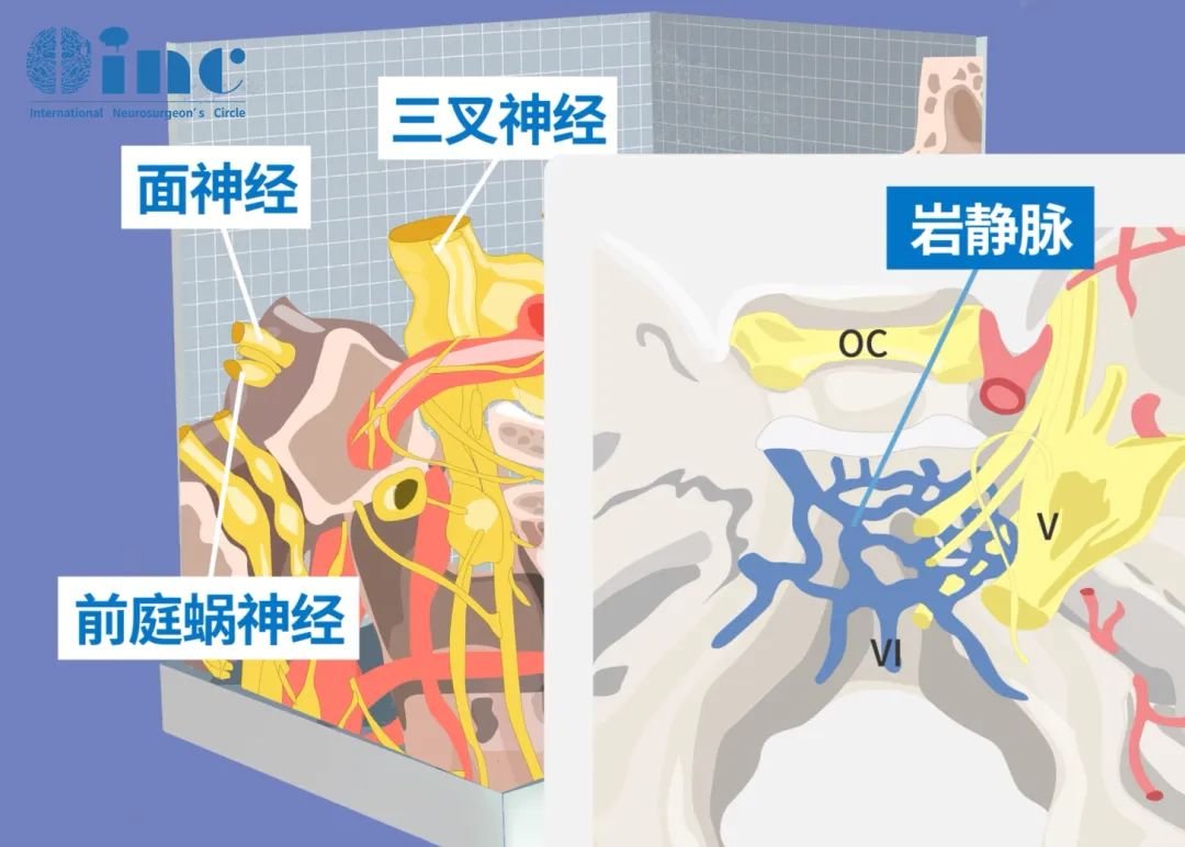 CPA桥小脑角区，是由脑干脑桥外缘、岩骨内缘和小脑半球前外侧缘构成的锥形三角空间，空间虽小但富藏着前庭蜗神经、面神经、三叉神经、岩静脉等重要解剖结构。