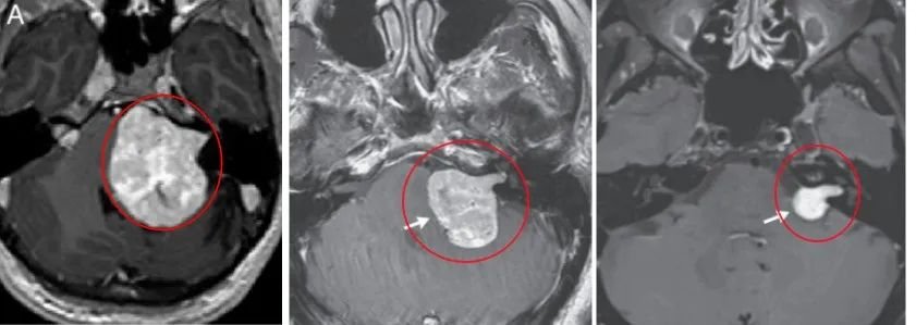 典型听神经瘤MRI影像呈冰淇淋甜筒征