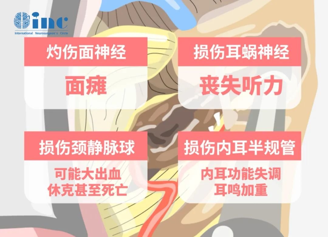 因为术中为了扩大术野充分暴露肿瘤需要磨除内听道，而面听神经穿过内听道进入颅内磨除内听道的过程极易灼伤面神经、损伤耳蜗神经、颈静脉球和内耳半规管。