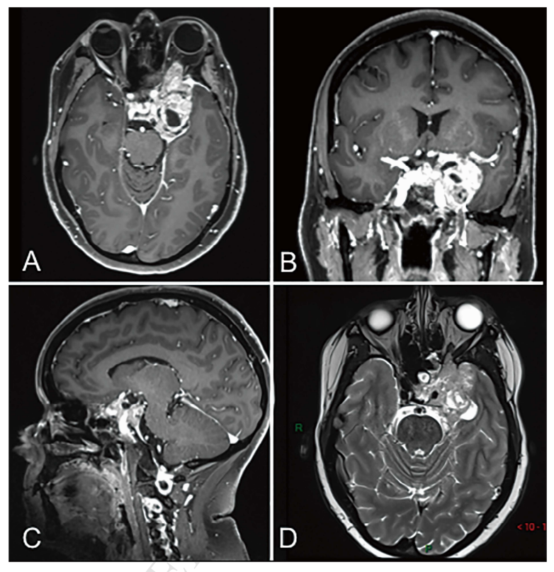 图1. 术前MRI示复发性海绵窦脑膜瘤，并侵及眼眶。