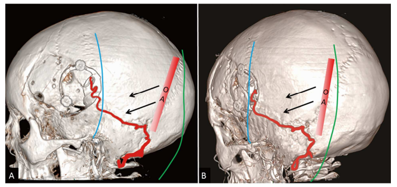 枕动脉-大脑中动脉(OA-MCA)搭桥示意图