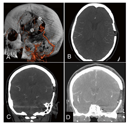 搭桥术后1周行DSA复查，确认吻合口及移植血管通畅(图5)