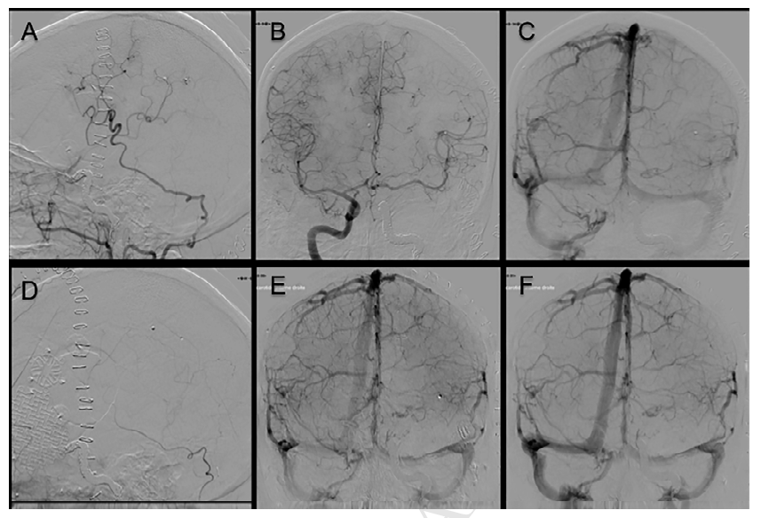 图7. 术后血管造影；A-C：搭桥术后1周造影示OA-MCA搭桥通畅。D-F：肿瘤切除术后1个月造影。整个术后过程中患者未出现新的神经功能障碍。