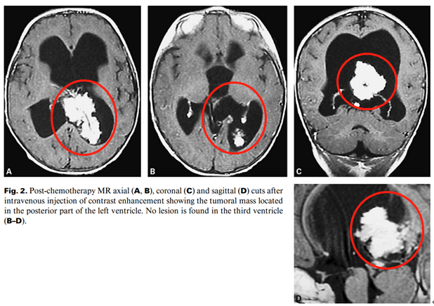 化疗后磁共振轴位(A, B)、冠状位(C)、矢状位(D)在静脉注射增强后显示位于左脑室后部的肿瘤肿块。