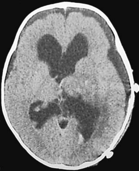 术后CT扫描显示肿瘤完全切除，存在轻微硬膜下积液以及脑室持续扩张，术后一周内即缓解。