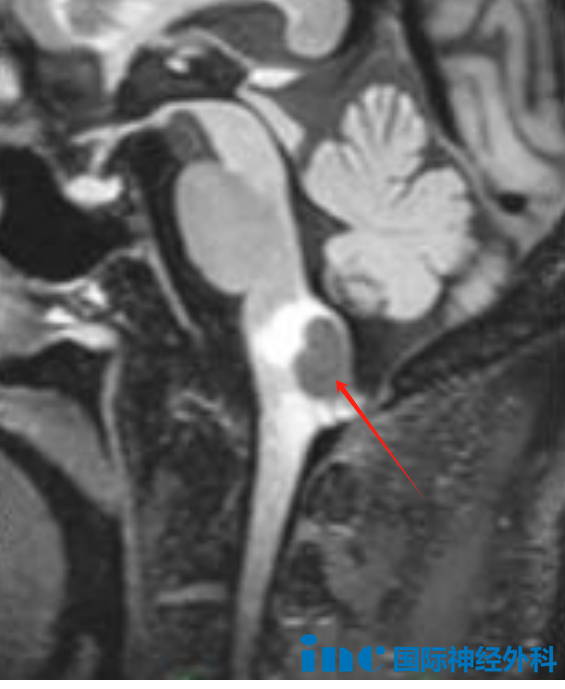 延髓背侧占位性病变