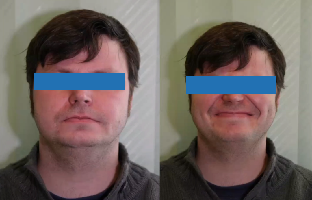 术中全切，术后无面瘫