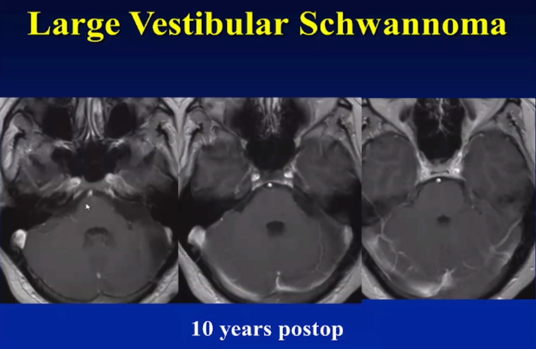 术后10年随访，一切正常