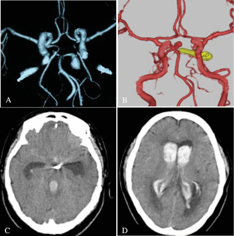 （A）之前的3D-CTA显示左侧P1动脉瘤被夹闭。（B）3D-CTA显示基底尖端部分的先前夹子和新发动脉瘤。（C&D）CT显示蛛网膜下腔出血伴脑室内血肿。