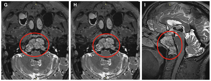 术前MRI显示一个大的斜坡脊索瘤延伸到蝶窦，寰枢椎、岩尖、下斜坡和右枕髁。