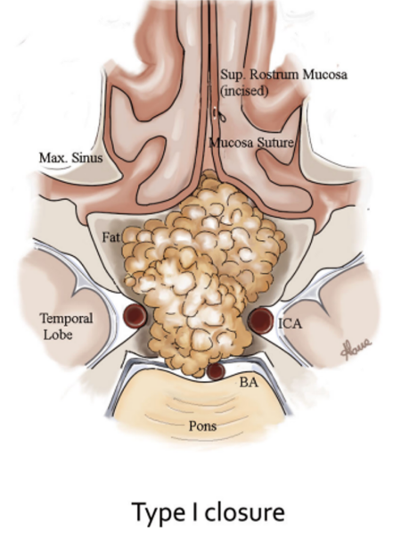在I型中，鼻粘膜在鼻窦的右侧或左侧切开，并用连续缝合。