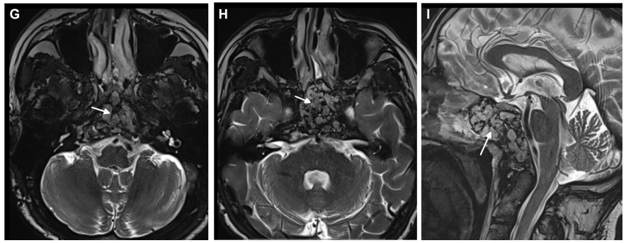 术后MRI证实肿瘤完全切除，显示用于术后残腔重建填充的脂肪(白色箭头表示脂肪移植)。