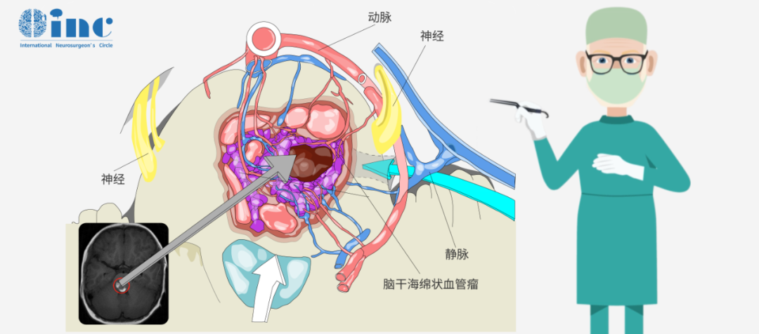脑干海绵状血管瘤并发静脉畸形需要处理吗?