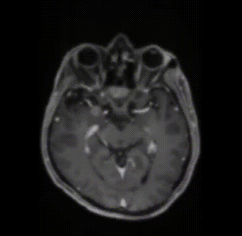 <a href='/bingzhong/naomoliu/' target='_blank'><u>脑膜瘤</u></a>