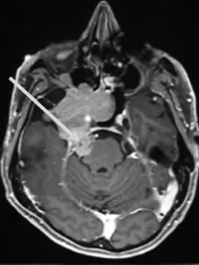 全方位切除肿瘤步骤