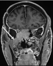 全方位切除肿瘤步骤