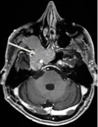 全方位切除肿瘤步骤