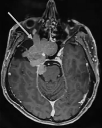 全方位切除肿瘤步骤