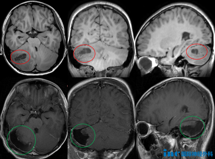 恶性<a href='/bingzhong/smxbl/' target='_blank'><u>髓母细胞瘤</u></a>治疗的重中之重，术后2年开心玩耍的他来告诉你！