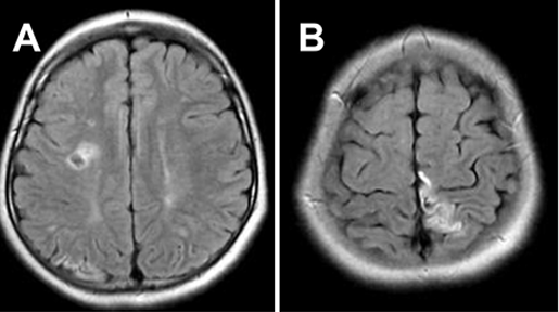 患者初次就诊时进行的 FLAIR MRI，显示 MMD 引起的双侧脑梗死