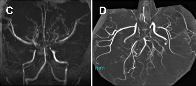 患者初次就诊时进行的MRA