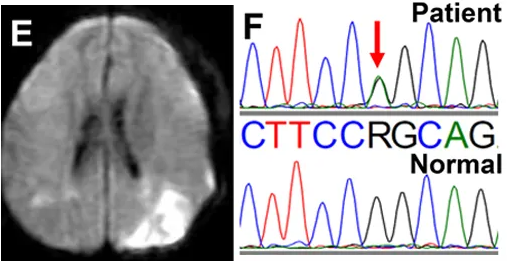 图E：左侧联合搭桥手术后进行的弥散加权 MRI 显示远离搭桥的区域发生意外脑梗死。 图F：DNA序列分析，鉴定了杂合子c.12185G>A （p.R4062Q）变体（在色谱图中由 R 表示 G>A 替换）。