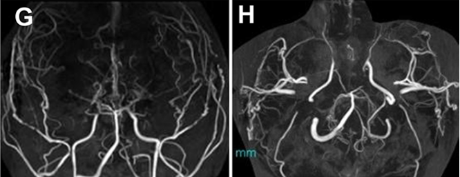 图G&H：发病5年后进行的MRA显示主要颅内动脉狭窄的显着进展。