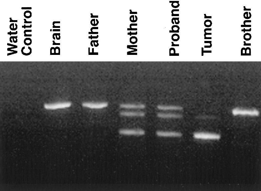 hSNF5 cDNA 部分片段的 RT-PCR 结果，显示了正常脑组织及父系和兄弟外周血白细胞（WBC）cDNA 的预期野生型产物。母系和先证者外周血白细胞 cDNA 显示野生型和突变型转录本，中间存在杂合双链。肿瘤 cDNA 仅显示突变型转录本，野生型等位基因丢失。