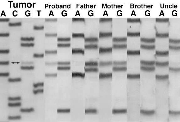 对先证者肿瘤、先证者种系以及母亲种系 DNA 的 hSNF5 第 7 外显子进行测序，显示在先证者肿瘤、先证者种系及母亲种系 DNA 中存在 G→A 突变（双箭头），而先证者父亲和兄弟的白细胞 DNA 显示野生型序列。先证者肿瘤和其舅舅的肿瘤（Uncle）显示出相同的 G→A 突变。