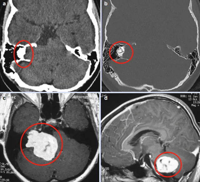术前CT和MR显示CPA区（桥小脑角区）有巨大均匀强化的肿瘤，病变向前上方延伸至颅中窝硬膜，向前内侧延伸至颈动脉岩段，尾侧至颈静脉孔。颞骨岩部严重受压迫损伤，脑干明显受压迫，但无脑积水，未检测到NF2的临床症状或放射学体征。