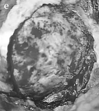 暴露乙状窦和横窦，进行乙状窦后入入路