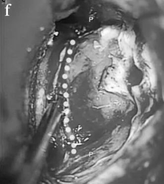 中部的肿瘤部分被一层很薄的骨板覆盖，骨板被钻掉，虚线显示了骨切除量，这部分最初被移除。